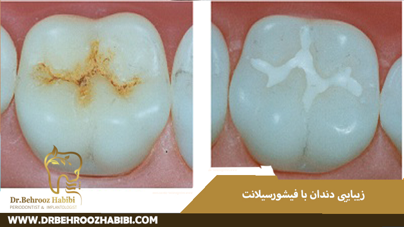 زیبایی دندان با فیشورسیلانت