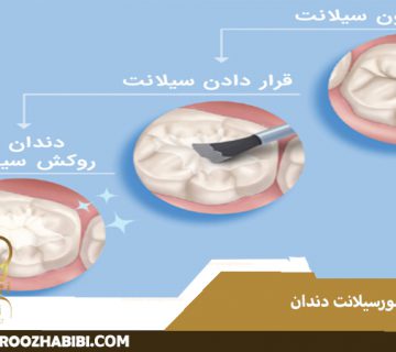 فیشور سیلانت دندان