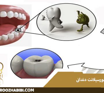 فیشور سیلانت دندانی