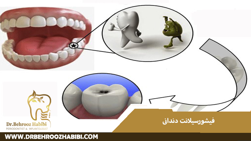 فیشور سیلانت دندانی