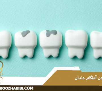 پر کردن آمالگام