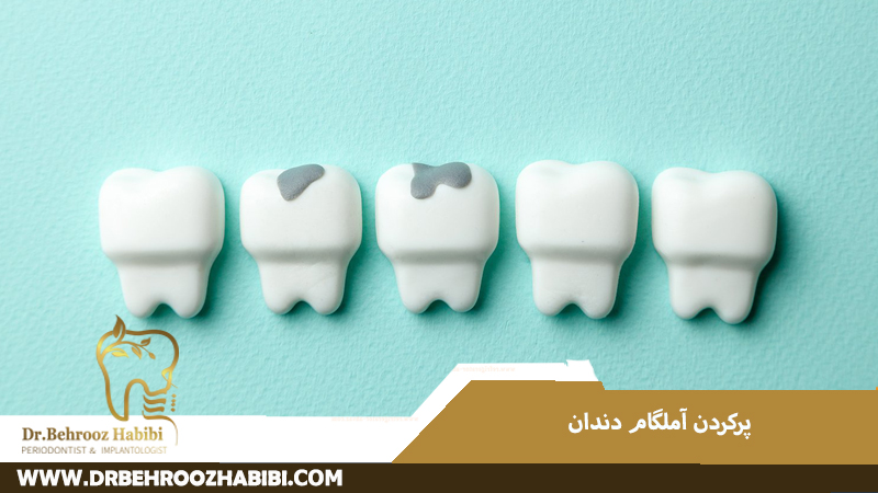 پر کردن آمالگام