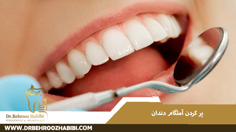 پرکردن آمالگام دندان