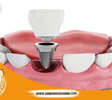 متخصص ایمپلنت در تهران