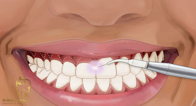 متخصص-ایمپلنت-در-تهران