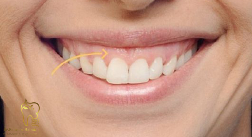 متخصص-ایمپلنت-در-تهران