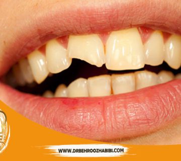 متخصص ایمپلنت در تهران