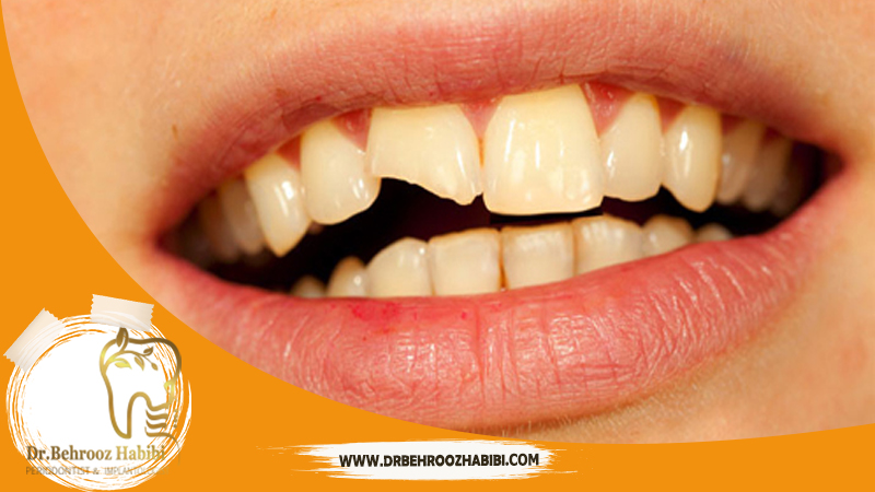 متخصص ایمپلنت در تهران