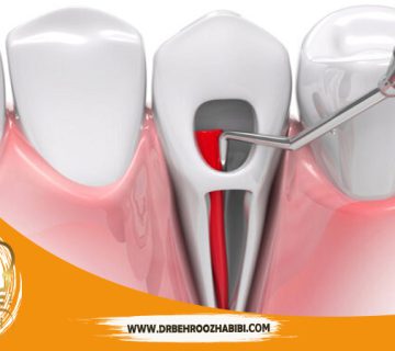 درمان کانال ریشه