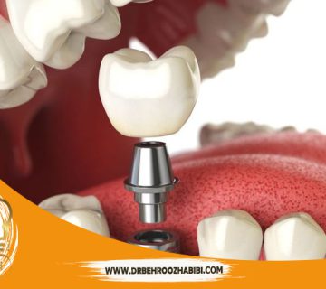 متخصص ایمپلنت در تهران