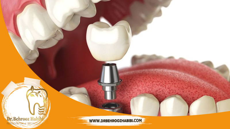 متخصص ایمپلنت در تهران