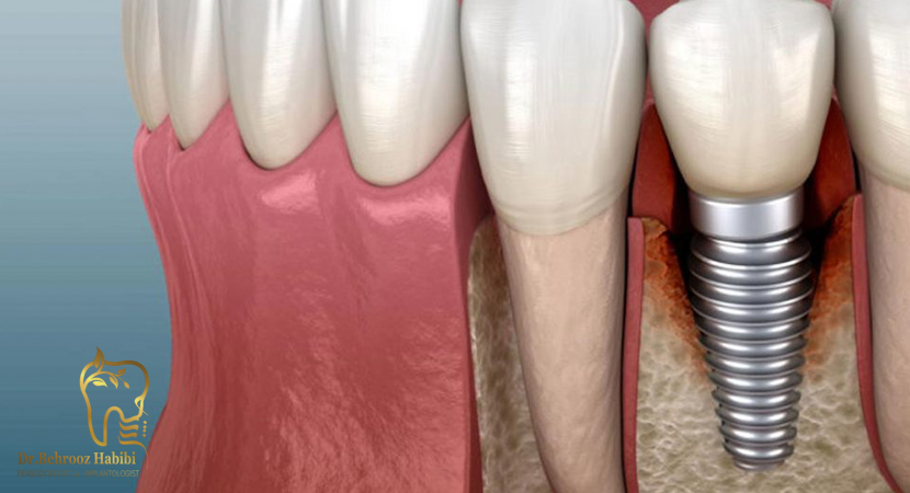 میانگین هزینه ایمپلنت دندان
