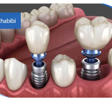 متخصص-ایمپلنت-در-تهران | دکتر-بهروز-حبیبی-در-تهران
