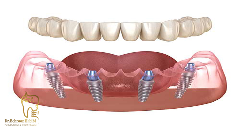انواع-ایمپلنت-های-دندانی