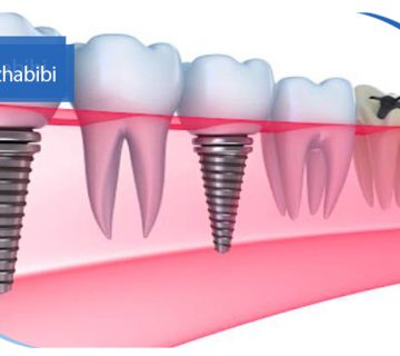 متخصص-ایمپلنت-در-تهران | دکتر-بهروز-حبیبی-در-تهران