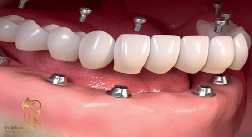 ایمپلنت-دندان-در-تهران