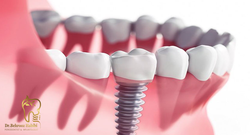 ایمپلنت-دندان-در-تهران