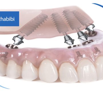 متخصص-ایمپلنت-در-تهران | دکتر-بهروز-حبیبی-در-تهران