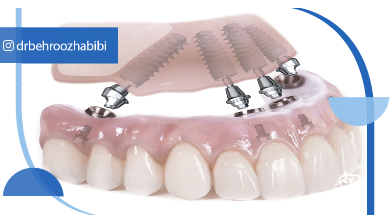 متخصص-ایمپلنت-در-تهران | دکتر-بهروز-حبیبی-در-تهران