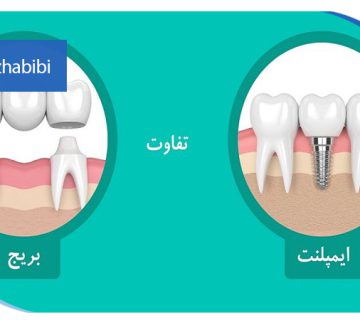 متخصص-ایمپلنت-در-تهران | دکتر-بهروز-حبیبی-در-تهران
