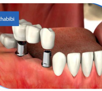 متخصص-ایمپلنت-در-تهران | دکتر-بهروز-حبیبی-در-تهران