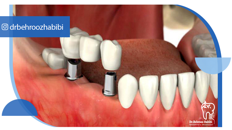 متخصص-ایمپلنت-در-تهران | دکتر-بهروز-حبیبی-در-تهران