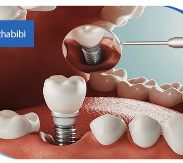 متخصص-ایمپلنت-در-تهران | دکتر-بهروز-حبیبی-در-تهران