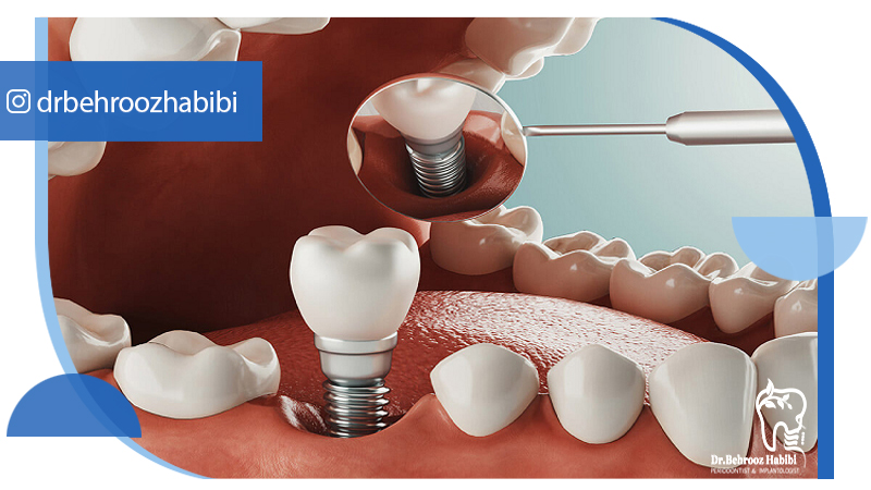 متخصص-ایمپلنت-در-تهران | دکتر-بهروز-حبیبی-در-تهران