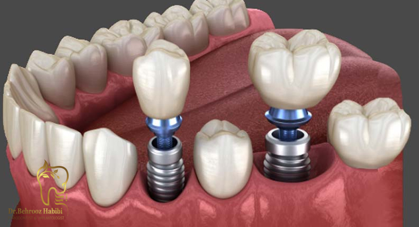 درمان-با-ایمپلنت-دندانی