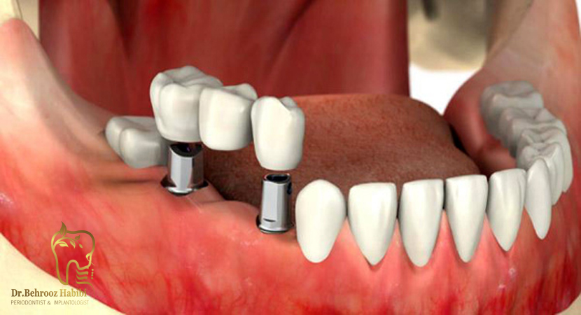 درمان-با-ایمپلنت-دندانی
