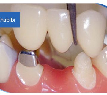 متخصص-ایمپلنت-در-تهران | دکتر-بهروز-حبیبی-در-تهران