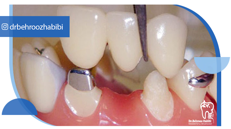 متخصص-ایمپلنت-در-تهران | دکتر-بهروز-حبیبی-در-تهران
