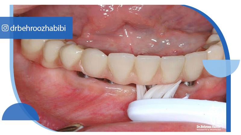 متخصص-ایمپلنت-در-تهران | دکتر-بهروز-حبیبی-در-تهران