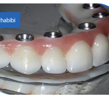 متخصص-ایمپلنت-در-تهران | دکتر-بهروز-حبیبی-در-تهران