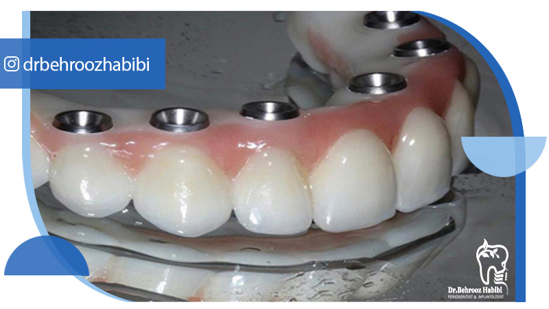متخصص-ایمپلنت-در-تهران | دکتر-بهروز-حبیبی-در-تهران