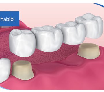 متخصص-ایمپلنت-در-تهران | دکتر-بهروز-حبیبی-در-تهران