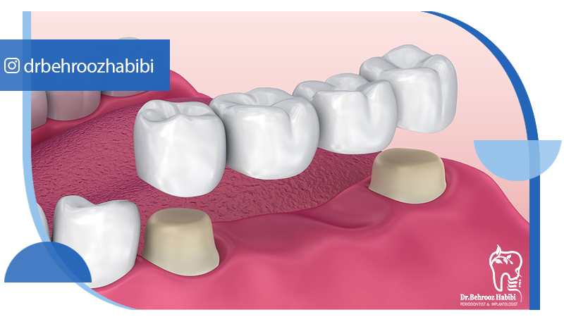 متخصص-ایمپلنت-در-تهران | دکتر-بهروز-حبیبی-در-تهران