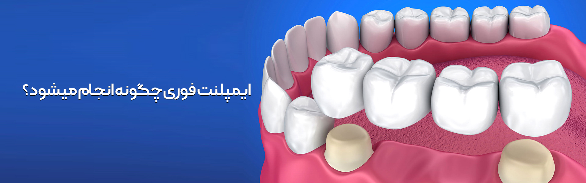 ایمپلنت فوری چگونه انجام می شود