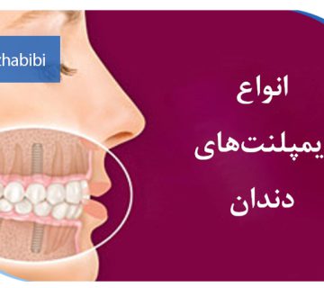 متخصص-ایمپلنت-در-تهران | دکتر-بهروز-حبیبی