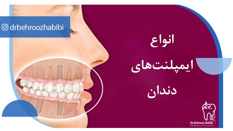 متخصص-ایمپلنت-در-تهران | دکتر-بهروز-حبیبی