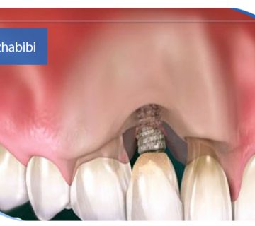 متخصص-ایمپلنت-در-تهران | دکتر-بهروز-حبیبی