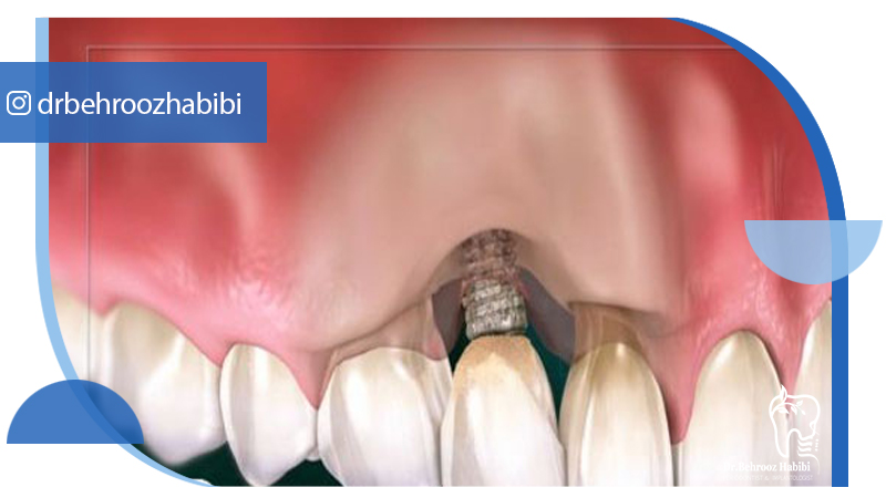 متخصص-ایمپلنت-در-تهران | دکتر-بهروز-حبیبی