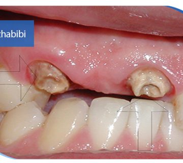 متخصص-ایمپلنت-در-تهران | دکتر-بهروز-حبیبی