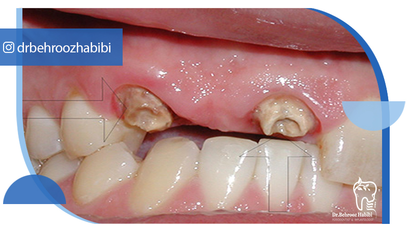 متخصص-ایمپلنت-در-تهران | دکتر-بهروز-حبیبی