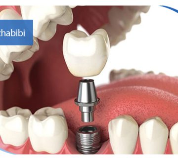 متخصص-ایمپلنت-در-تهران | دکتر-بهروز-حبیبی