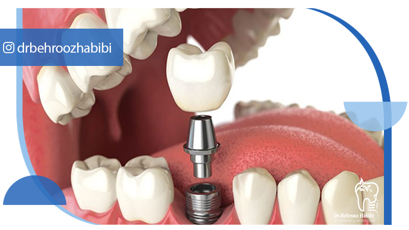 متخصص-ایمپلنت-در-تهران | دکتر-بهروز-حبیبی