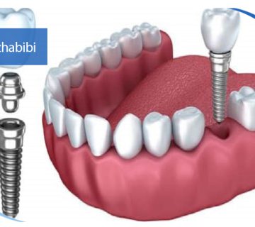متخصص-ایمپلنت-در-تهران | دکتر-بهروز-حبیبی
