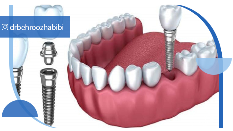 متخصص-ایمپلنت-در-تهران | دکتر-بهروز-حبیبی