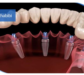 متخصص-ایمپلنت-در-تهران | دکتر-بهروز-حبیبی