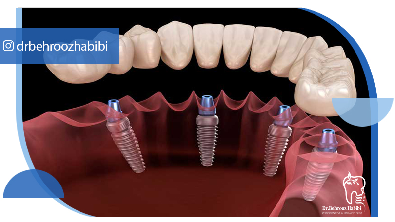 متخصص-ایمپلنت-در-تهران | دکتر-بهروز-حبیبی